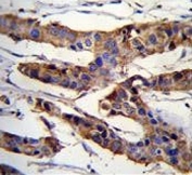 IHC testing of FFPE human breast cancer tissue with ZBTB24 antibody. HIER: steam section in pH6 citrate buffer for 20 min and allow to cool prior to staining.
