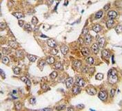 IHC testing of FFPE human breast cancer tissue with Bcl-W antibody. HIER: steam section in pH6 citrate buffer for 20 min and allow to cool prior to staining.
