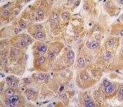 IHC testing of FFPE human hepatocellular carcinoma tissue with IDE antibody. HIER: steam section in pH6 citrate buffer for 20 min and allow to cool prior to staining.