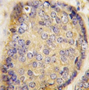 IHC testing of FFPE human prostate carcinoma tissue with LXN antibody. HIER: steam section in pH6 citrate buffer for 20 min and allow to cool prior to staining.