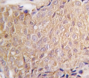 IHC testing of FFPE human breast carcinoma tissue with ALDH6A1 antibody. HIER: steam section in pH6 citrate buffer for 20 min and allow to cool prior to staining.