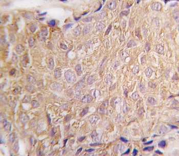 IHC testing of FFPE human breast carcinoma tissue with ALDH6A1 antibody. HIER: steam section in pH6 citrate buffer for 20 min and allow to cool prior to staining.