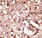 IHC testing of FFPE human breast cancer tissue with LYVE1 antibody. HIER: steam section in pH6 citrate buffer for 20 min and allow to cool prior to staining.