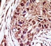 IHC testing of FFPE human cancer tissue with USP14 antibody. HIER: steam section in pH6 citrate buffer for 20 min and allow to cool prior to staining.