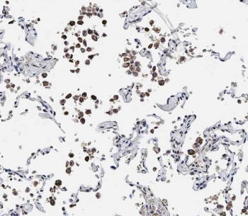 IHC testing of FFPE human lung tissue with ADAMTS17 antibody. HIER: steam section in pH9 EDTA for 20 min and allow to cool prior to staining.~