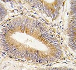 IHC testing of FFPE human colon carcinoma tissue with AKR1B1 antibody. HIER: steam section in pH6 citrate buffer for 20 min and allow to cool prior to staining.