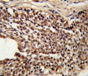 IHC testing of FFPE human prostate carcinoma tissue with TPI1 antibody. HIER: steam section in pH6 citrate buffer for 20 min and allow to cool prior to staining.
