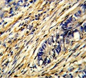 IHC testing of FFPE human colon carcinoma tissue with YWHAG antibody. HIER: steam section in pH6 citrate buffer for 20 min and allow to cool prior to staining.