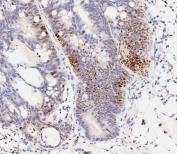 IHC testing of FFPE human colon carcinoma tissue with phospho-CREB antibody antibody. HIER: steam section in pH9 EDTA for 20 min and allow to cool prior to staining.