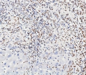IHC testing of FFPE human hepatocarcinoma tissue with phospho-CREB antibody antibody. HIER: steam section in pH9 EDTA for 20 min and allow to cool prior to staining.