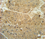 IHC testing of FFPE human hepatocarcinoma tissue with ADH1C antibody. HIER: steam section in pH6 citrate buffer for 20 min and allow to cool prior to staining.