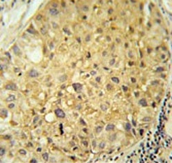 IHC testing of FFPE human hepatocarcinoma tissue with AADC antibody. HIER: steam section in pH6 citrate buffer for 20 min and allow to cool prior to staining.