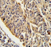 IHC testing of FFPE human lung carcinoma tissue with CTSE antibody. HIER: steam section in pH6 citrate buffer for 20 min and allow to cool prior to staining.