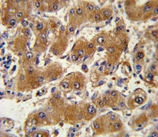 IHC testing of FFPE human hepatocarcinoma tissue with COL6A1 antibody. HIER: steam section in pH6 citrate buffer for 20 min and allow to cool prior to staining.