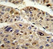 IHC testing of FFPE human hepatocarcinoma tissue with Serpin C1 antibody. HIER: steam section in pH6 citrate buffer for 20 min and allow to cool prior to staining.
