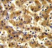 IHC testing of FFPE human hepatocarinoma tissue with ADH1B antibody. HIER: steam section in pH6 citrate buffer for 20 min and allow to cool prior to staining.