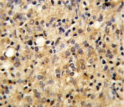 IHC testing of FFPE human prostate carcinoma tissue with TSP5 antibody. HIER: steam section in pH6 citrate buffer for 20 min and allow to cool prior to staining.