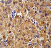 IHC testing of FFPE human hepatocarcinoma tissue with Cystathionine Beta Synthase antibody. HIER: steam section in pH6 citrate buffer for 20 min and allow to cool prior to staining.
