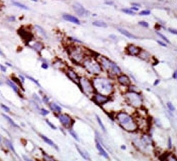 IHC testing of FFPE human breast cancer tissue with GRK5 antibody. HIER: steam section in pH6 citrate buffer for 20 min and allow to cool prior to staining.