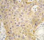 IHC testing of FFPE human hepatocarcinoma tissue with GRK5 antibody. HIER: steam section in pH6 citrate buffer for 20 min and allow to cool prior to staining.