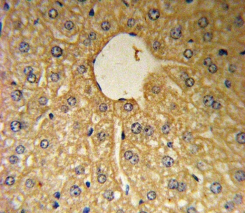 IHC testing of FFPE human hepatocarcinoma tissue with MSRA antibody. HIER: steam section in pH6 citrate buffer for 20 min and allow to cool prior to staining.