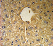 IHC testing of FFPE human hepatocarcinoma tissue with MSRA antibody. HIER: steam section in pH6 citrate buffer for 20 min and allow to cool prior to staining.