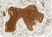 IHC testing of FFPE human breast cancer tissue with BCOR antibody. HIER: steam section in pH6 citrate buffer for 20 min and allow to cool prior to staining.