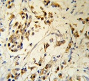IHC testing of FFPE human breast carcinoma tissue with RBM3 antibody. HIER: steam section in pH6 citrate buffer for 20 min and allow to cool prior to staining.