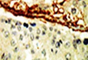 IHC testing of FFPE human breast cancer tissue with EphA4 antibody. HIER: steam section in pH6 citrate buffer for 20 min and allow to cool prior to staining.