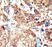 IHC testing of FFPE human breast cancer tissue with Eph Receptor B1 antibody. HIER: steam section in pH6 citrate buffer for 20 min and allow to cool prior to staining.
