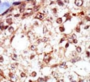 IHC testing of FFPE human breast cancer tissue with FGR antibody. HIER: steam section in pH6 citrate buffer for 20 min and allow to cool prior to staining.