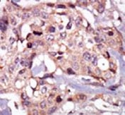 IHC testing of FFPE human breast cancer tissue with Tec antibody. HIER: steam section in pH6 citrate buffer for 20 min and allow to cool prior to staining.