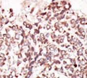 IHC testing of FFPE human cancer tissue with PIM2 antibody. HIER: steam section in pH6 citrate buffer for 20 min and allow to cool prior to staining.