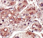 IHC testing of FFPE human cancer tissue with MEK2 antibody. HIER: steam section in pH6 citrate buffer for 20 min and allow to cool prior to staining.