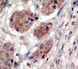 IHC testing of FFPE human cancer tissue with PI4K2A antibody. HIER: steam section in pH6 citrate buffer for 20 min and allow to cool prior to staining.