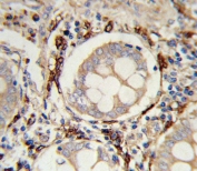 IHC testing of FFPE human colon carcinoma tissue with VAP-1 antibody. HIER: steam section in pH6 citrate buffer for 20 min and allow to cool prior to staining.