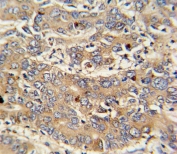 IHC testing of FFPE human hepatocarcinoma tissue with PIGR antibody. HIER: steam section in pH6 citrate buffer for 20 min and allow to cool prior to staining.