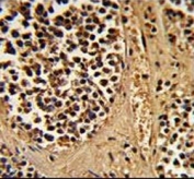 IHC testing of FFPE human kidney carcinoma tissue with Estrogen-Related Receptor Alpha antibody. HIER: steam section in pH6 citrate buffer for 20 min and allow to cool prior to staining.