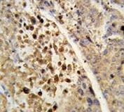IHC testing of FFPE human hepatocarcinoma tissue with PXR antibody. HIER: steam section in pH6 citrate buffer for 20 min and allow to cool prior to staining.