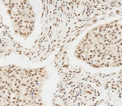 IHC testing of FFPE human lung adenocarcinoma tissue with HSPA7 antibody. HIER: steam section in pH6 citrate buffer for 20 min and allow to cool prior to staining.