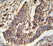 IHC testing of FFPE human lung carcinoma tissue with SCNN1A antibody. HIER: steam section in pH6 citrate buffer for 20 min and allow to cool prior to staining.