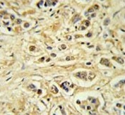 IHC testing of FFPE human breast carcinoma tissue with ZNF202 antibody. HIER: steam section in pH6 citrate buffer for 20 min and allow to cool prior to staining.