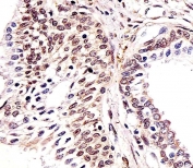 IHC testing of FFPE human prostate tissue with Histone H2AX antibody. HIER: steam section in pH6 citrate buffer for 20 min and allow to cool prior to staining.