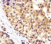 IHC testing of FFPE human breast cancer tissue with VCP antibody. HIER: steam section in pH6 citrate buffer for 20 min and allow to cool prior to staining.