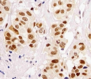 IHC testing of FFPE human breast cancer tissue with PCNA antibody. HIER: steam section in pH6 citrate buffer for 20 min and allow to cool prior to staining.