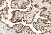 IHC testing of FFPE human ovarian cancer tissue with PCNA antibody. HIER: steam section in pH6 citrate buffer for 20 min and allow to cool prior to staining.