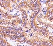 IHC testing of FFPE human thyroid carcinoma tissue with HSD17B10 antibody. HIER: steam section in pH6 citrate buffer for 20 min and allow to cool prior to staining.