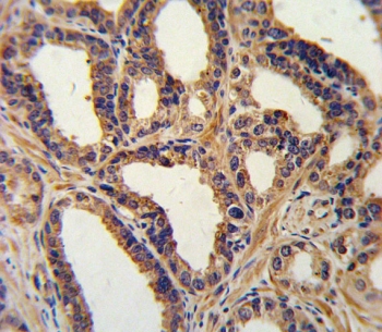 IHC testing of FFPE human prostate carcinoma tissue with NPPA antibody. HIER: steam section in pH6 citrate buffer for 20 min and allow to cool prior to staining.