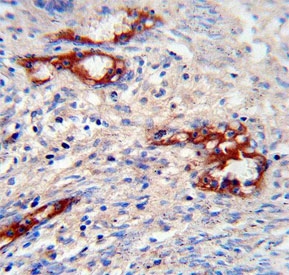 IHC testing of FFPE human prostate carcinoma tissue with MMP2 antibody. HIER: steam section in pH6 citrate buffer for 20 min and allow to cool prior to staining.