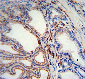 IHC testing of FFPE human gastric carcinoma tissue with MMP2 antibody. HIER: steam section in pH6 citrate buffer for 20 min and allow to cool prior to staining.